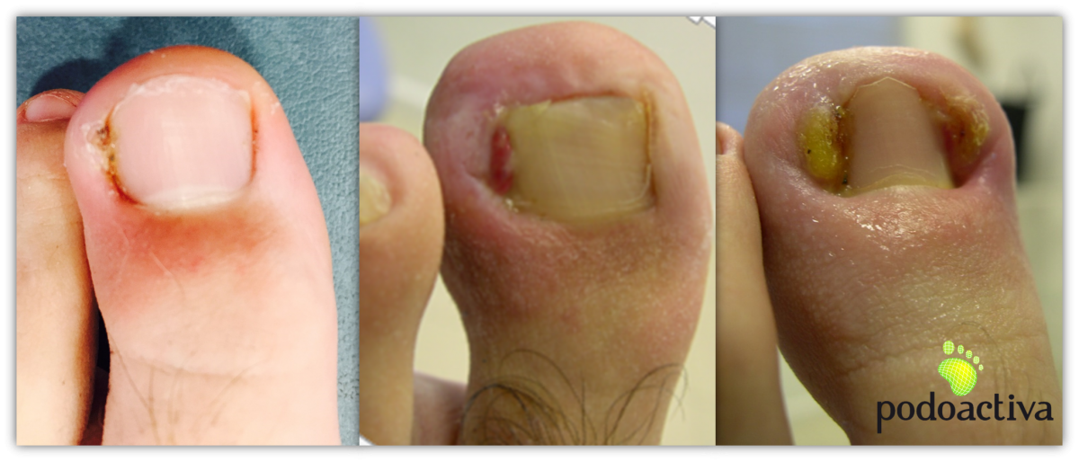 Problemas más comunes en las uñas de los pies Causas y tratamientos   Podoactiva Líderes en Podología