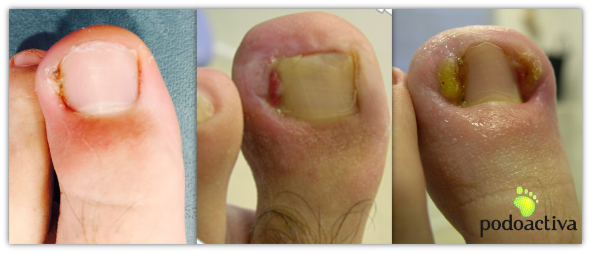 En general Elasticidad Cromático Problemas más comunes en las uñas de los pies. Causas y tratamientos - Podoactiva. Líderes en Podología En general Elasticidad Cromático Problemas más comunes en las uñas de los pies. Causas y tratamientos - Podoactiva. Líderes en Podología