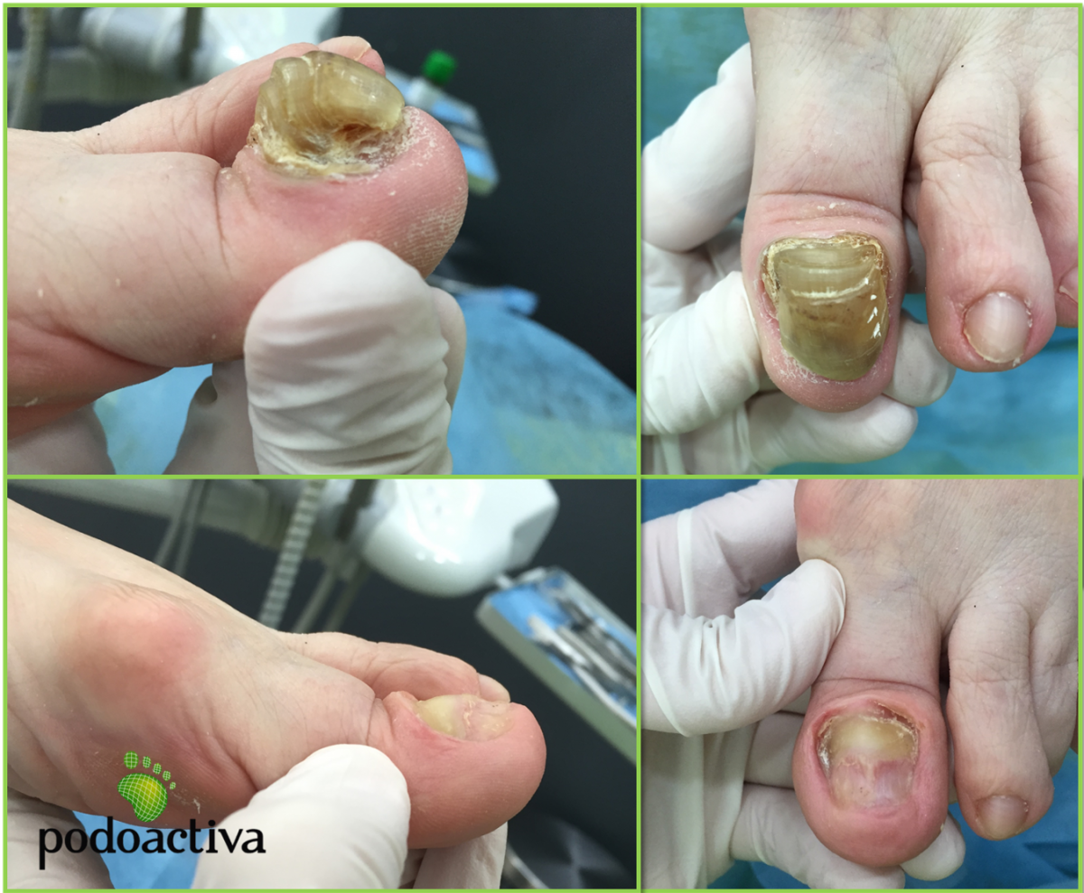 Traumatismos en las uñas causas tratamiento cuidados y fotos