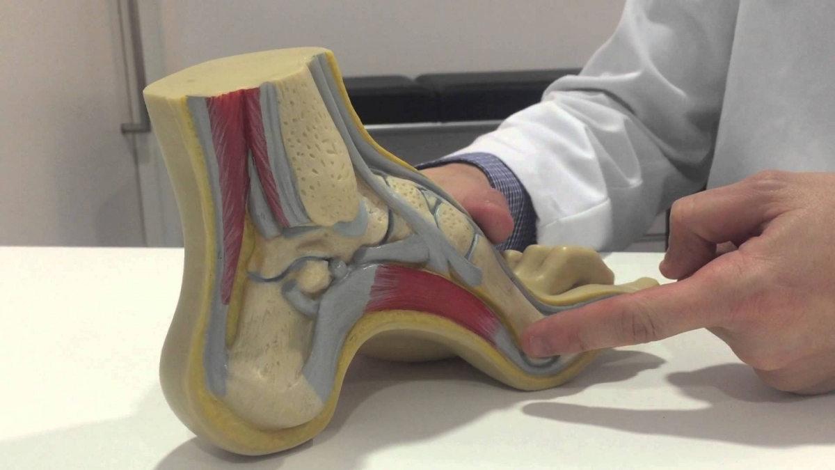 Pie cavo Características y tratamiento