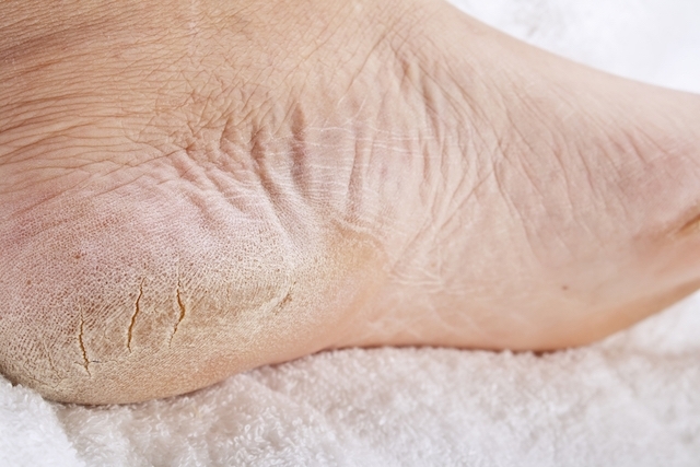 11 síntomas de mala circulación en pies y piernas (y tratamiento) - Tua  Saúde