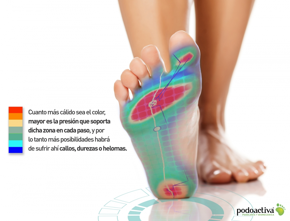 Callos en los pies o callosidades. Cómo tratarlos y cómo prevenirlos