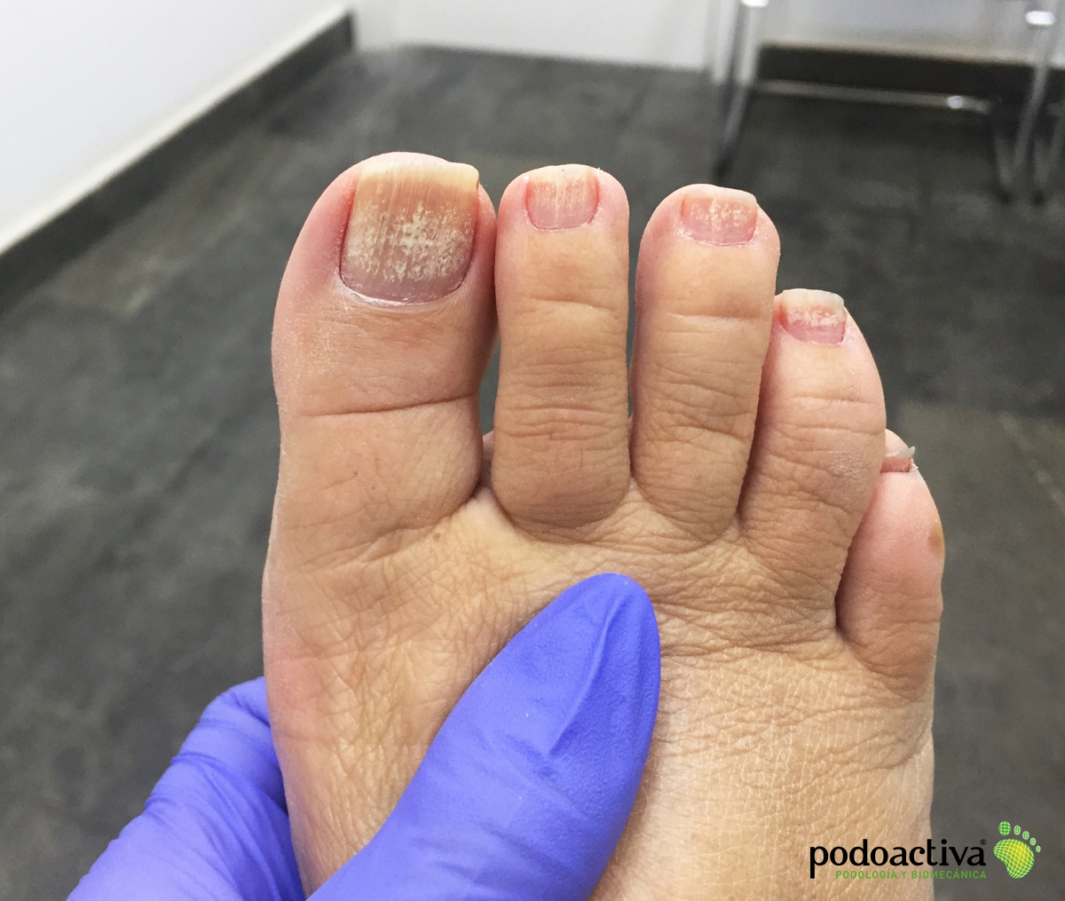 Psoriasis En Las Unas De Los Pies My XXX Hot Girl Psoriasis En Las Unas De Los Pies My XXX Hot Girl
