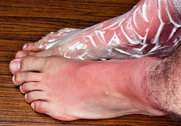 Sunburn On The Feet How Can I Protect My Feet From The Sun
