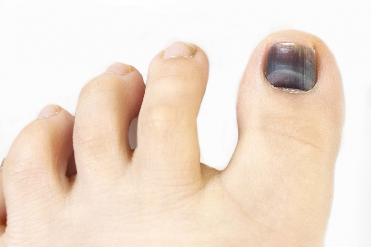 Problemas más comunes en las uñas de los pies. Causas y tratamientos -  Podoactiva. Líderes en Podología