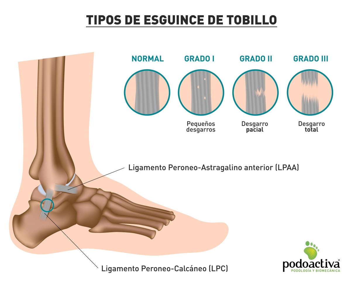 infografía con los tipos de esguince de tobillo que hay