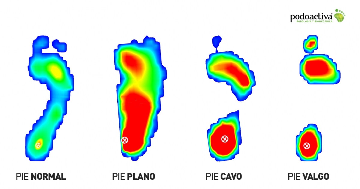 Huella plantar. Tipos, qué dice sobre tus pies y cómo se puede analizar