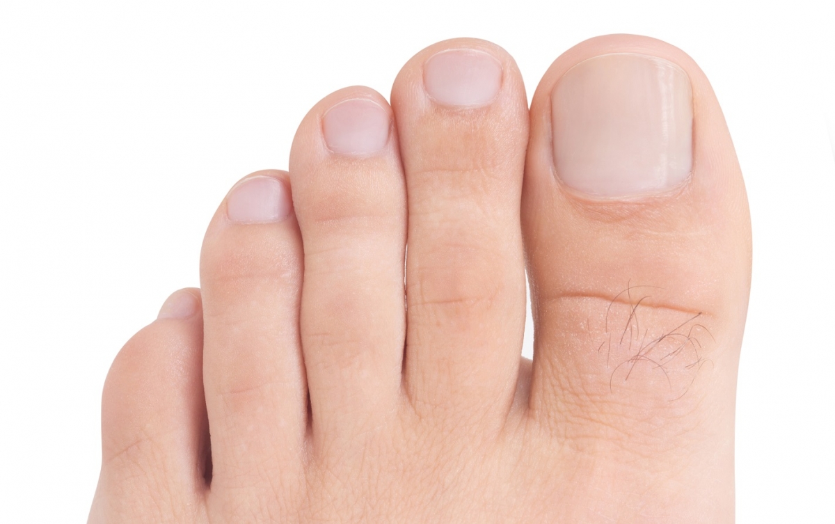 Problemas comunes en las uñas de los pies. Causas y tratamientos - Podoactiva. Líderes en Podología