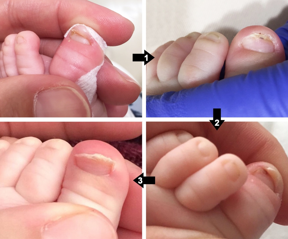 Las uñas del recién nacido Blog