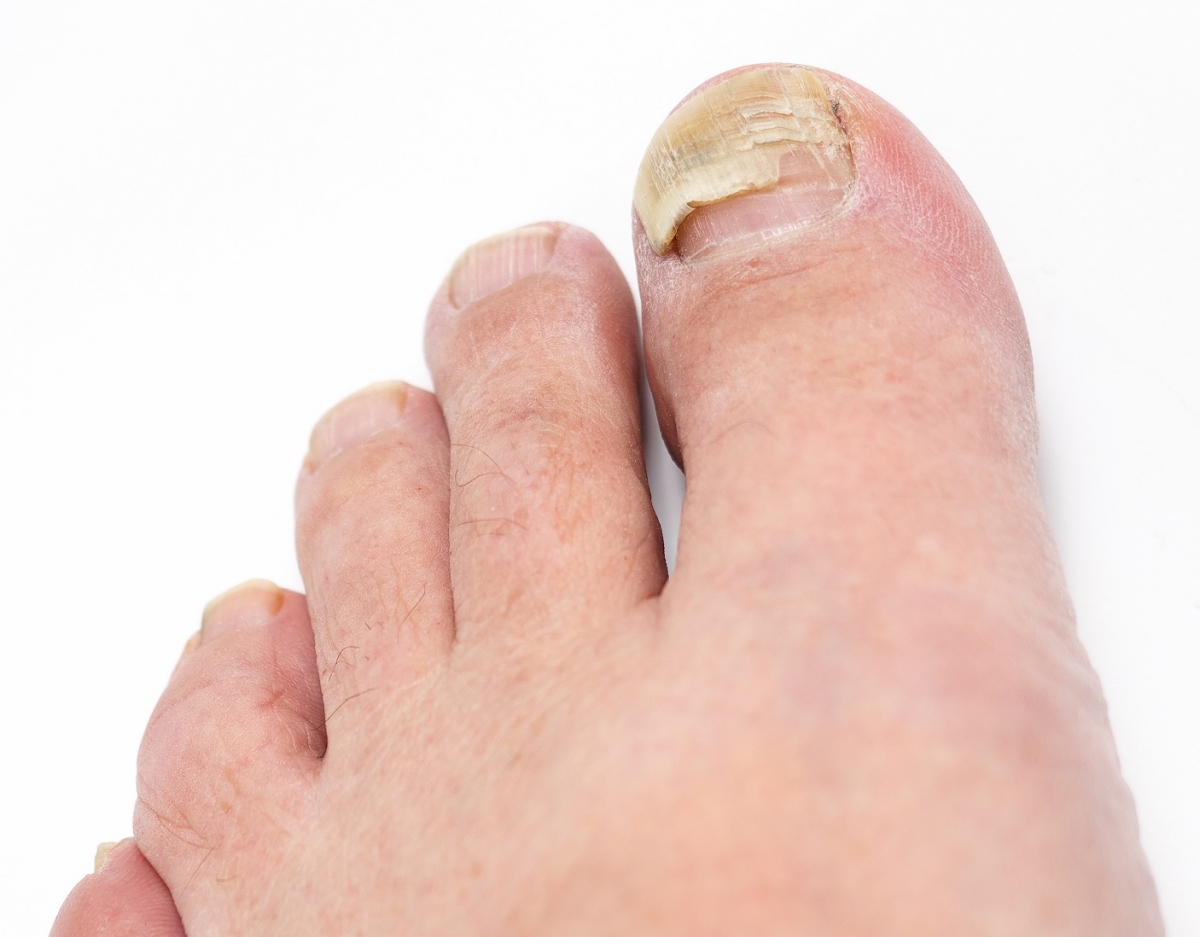 Antes y después del tratamiento para la infección por hongos en las uñas de  los pies  Foto Premium