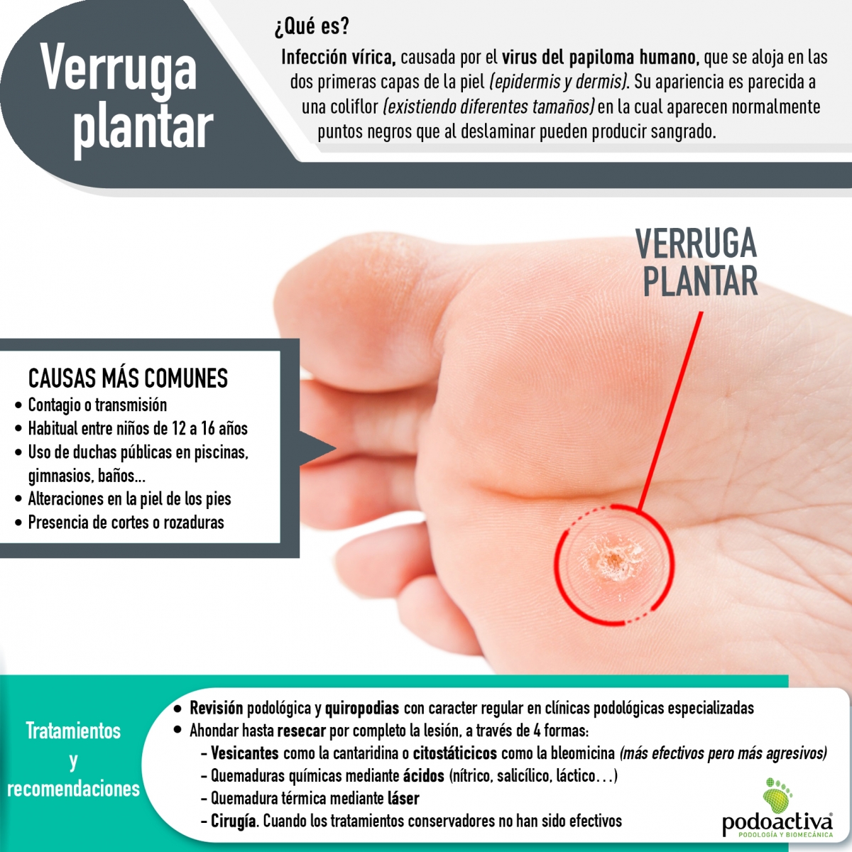 Infografía propia de Podoactiva sobre verrugas plantares