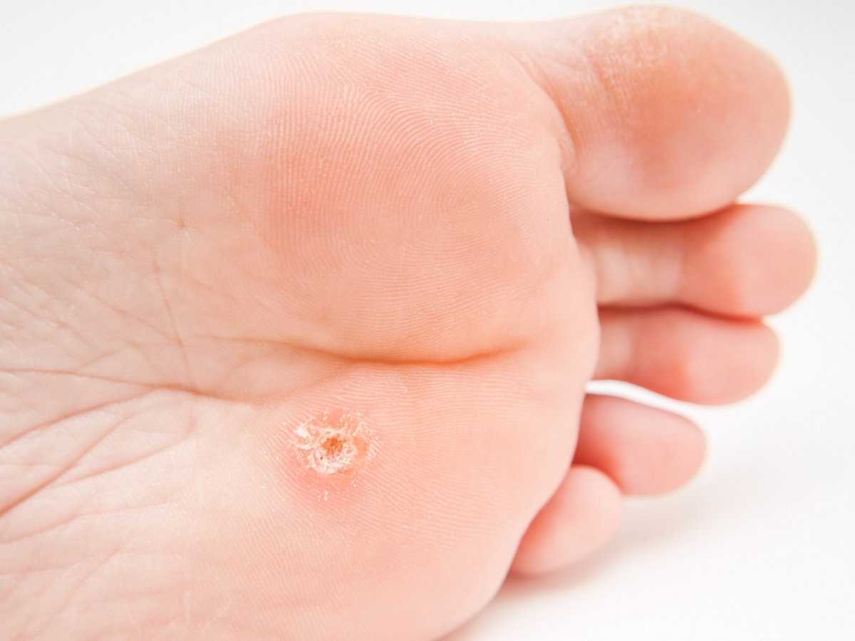 plantar wart on the sole of the foot