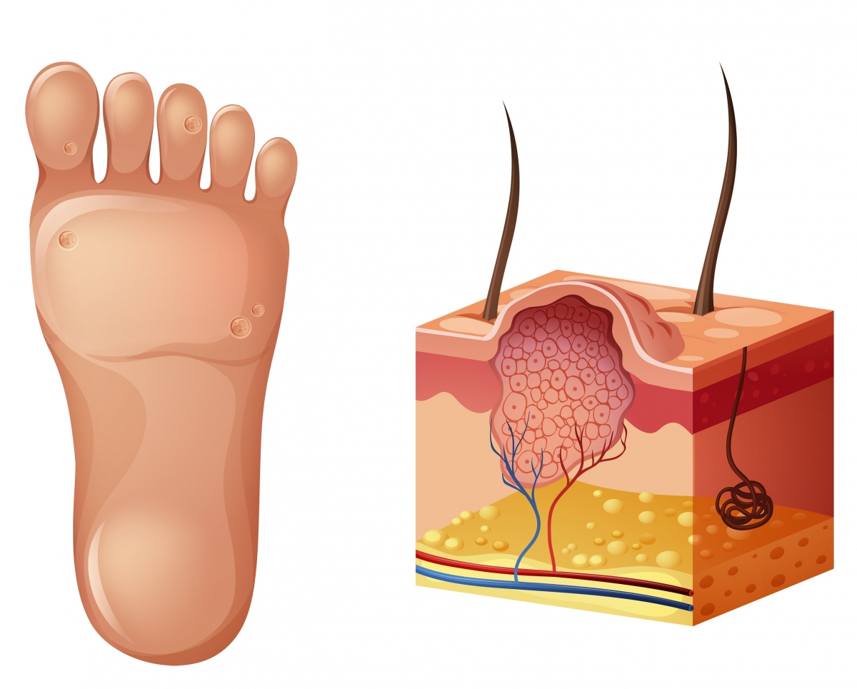 Detailed image of plantar warts on the feet