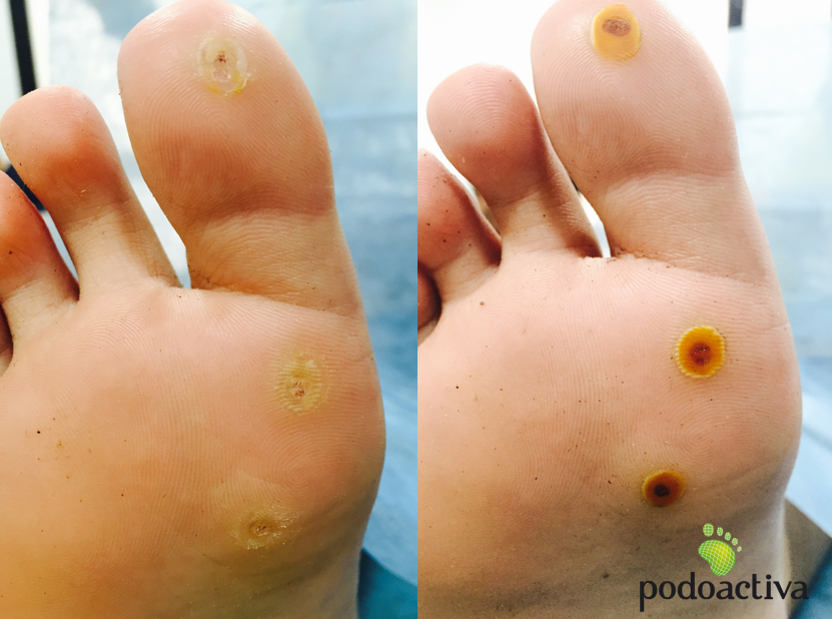 Tratamiento químico sobre verrugas plantares en los pies, el antes y el después
