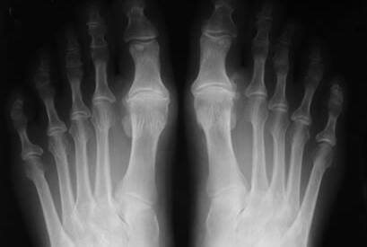 Hallux Rigidus